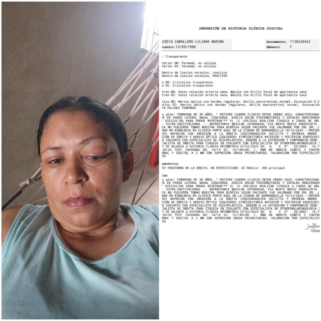 “No puedo ver bien por un ojo, siento que me me ahogo y no tengo respuesta médica”: mujer que presenta masa en la nariz denuncia desatención  por parte de EPS Mutualser